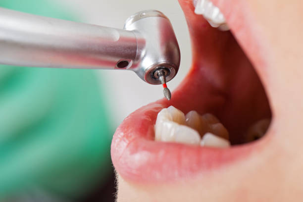 Best Emergency Root Canal Treatment in Zion, IL
